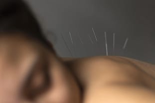 Acupuncture near Preston at Advanced Health Preston