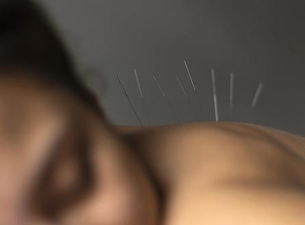 Acupuncture Preston