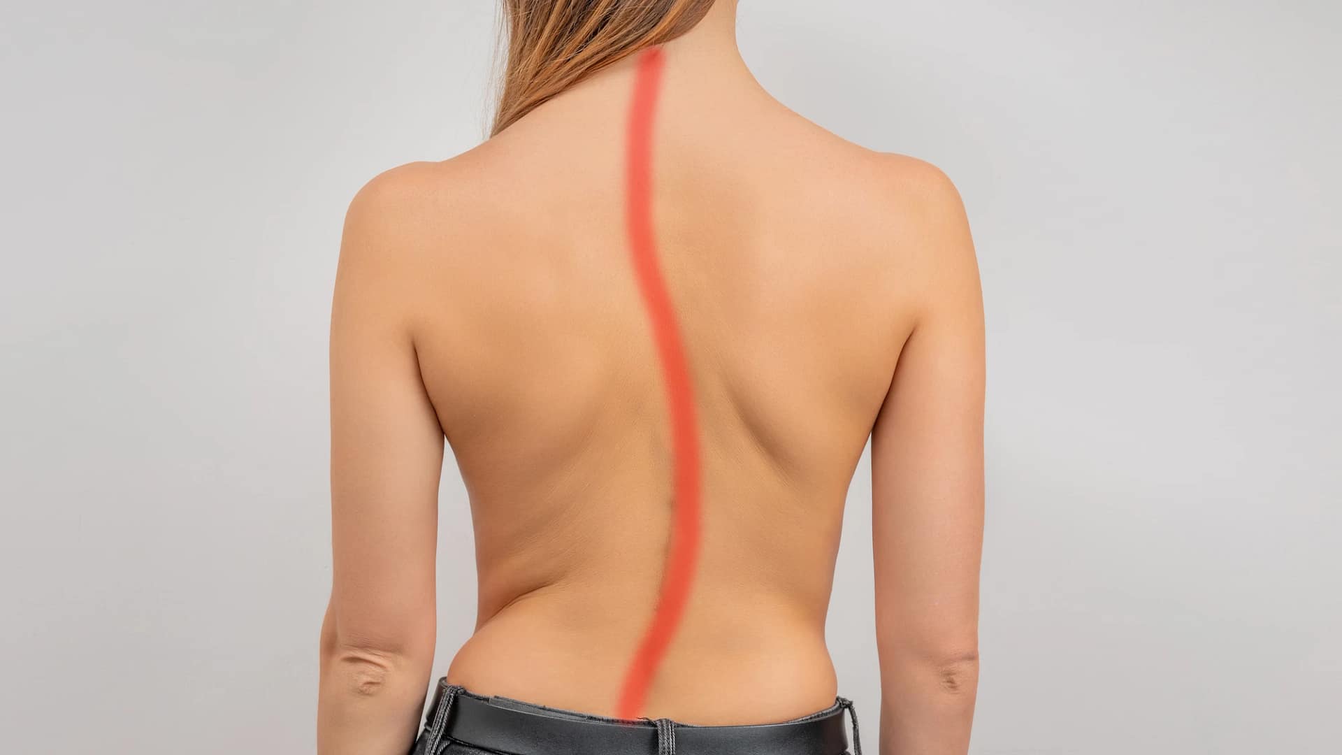 Scoliosis Preston