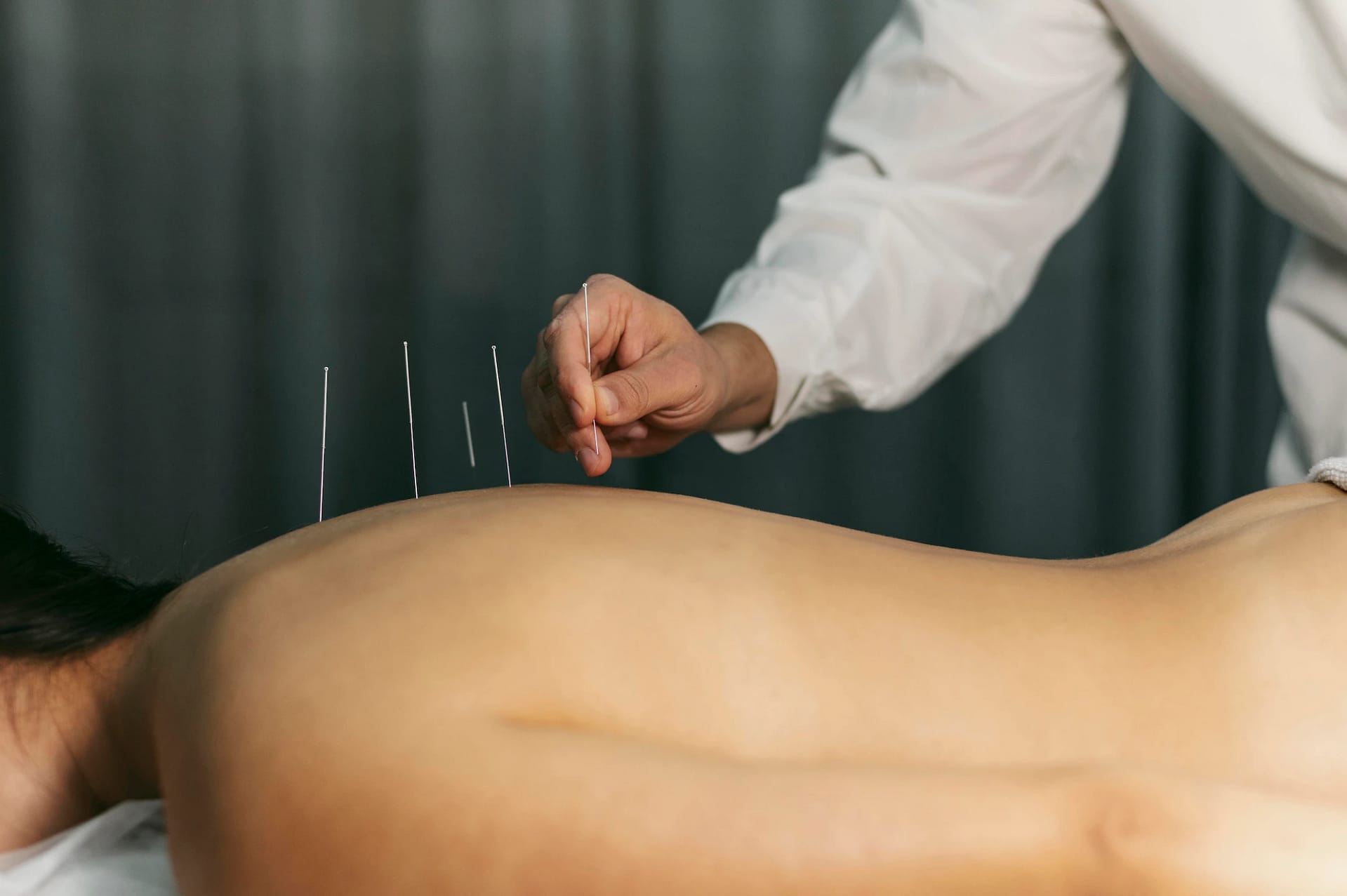 Acupuncture Services Preston