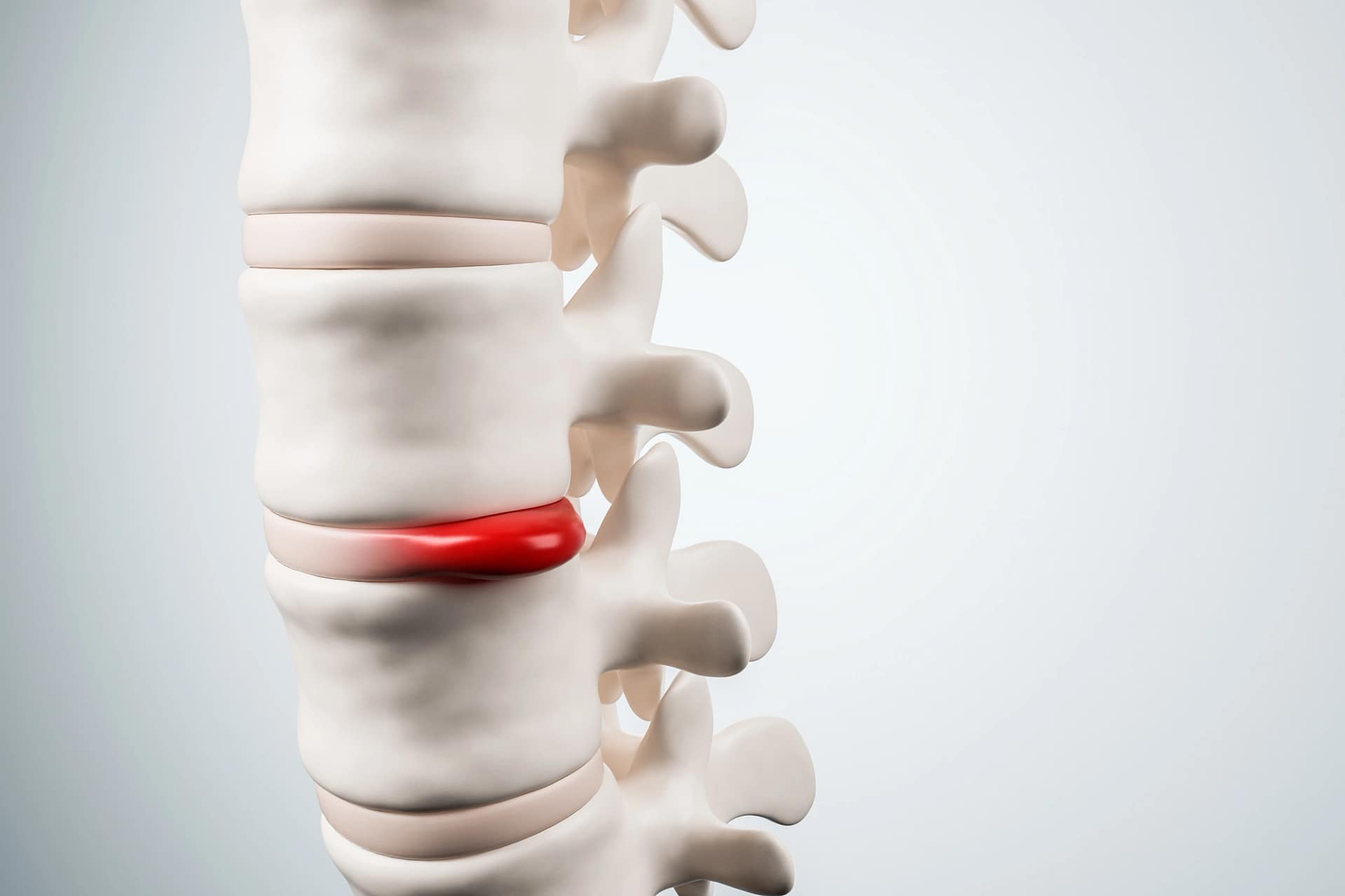 Best Sciatica – Leg Nerve Pain Treatment Preston