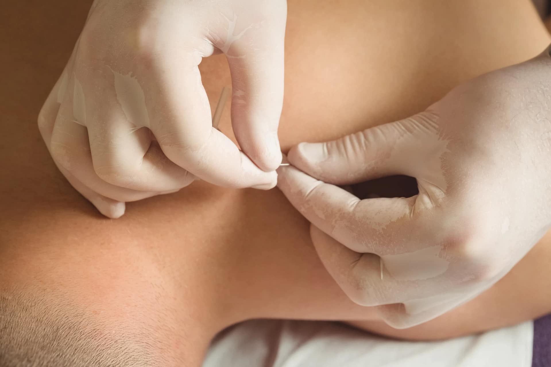 Acupuncture Clinic Preston