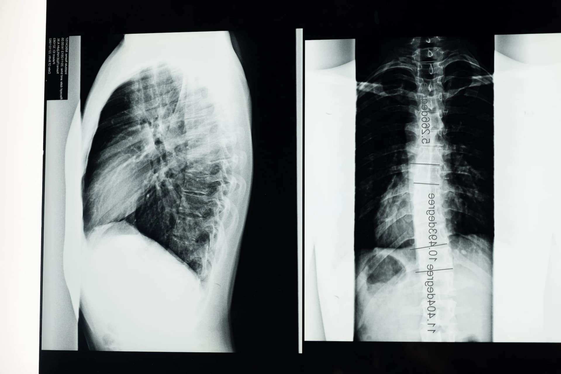 Scoliosis Treatment Preston