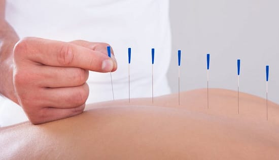 Acupuncture Therapy